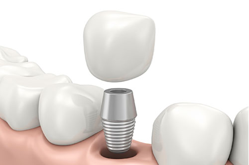 Don’t Be Ashamed of Missing Teeth. Get Dental Implants! [Infographic]