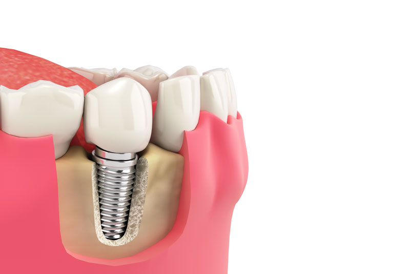 How Do Dental Implants Improve My Smile?